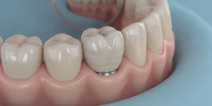 Implant emergence profile restoration with natural soft-tissue contour